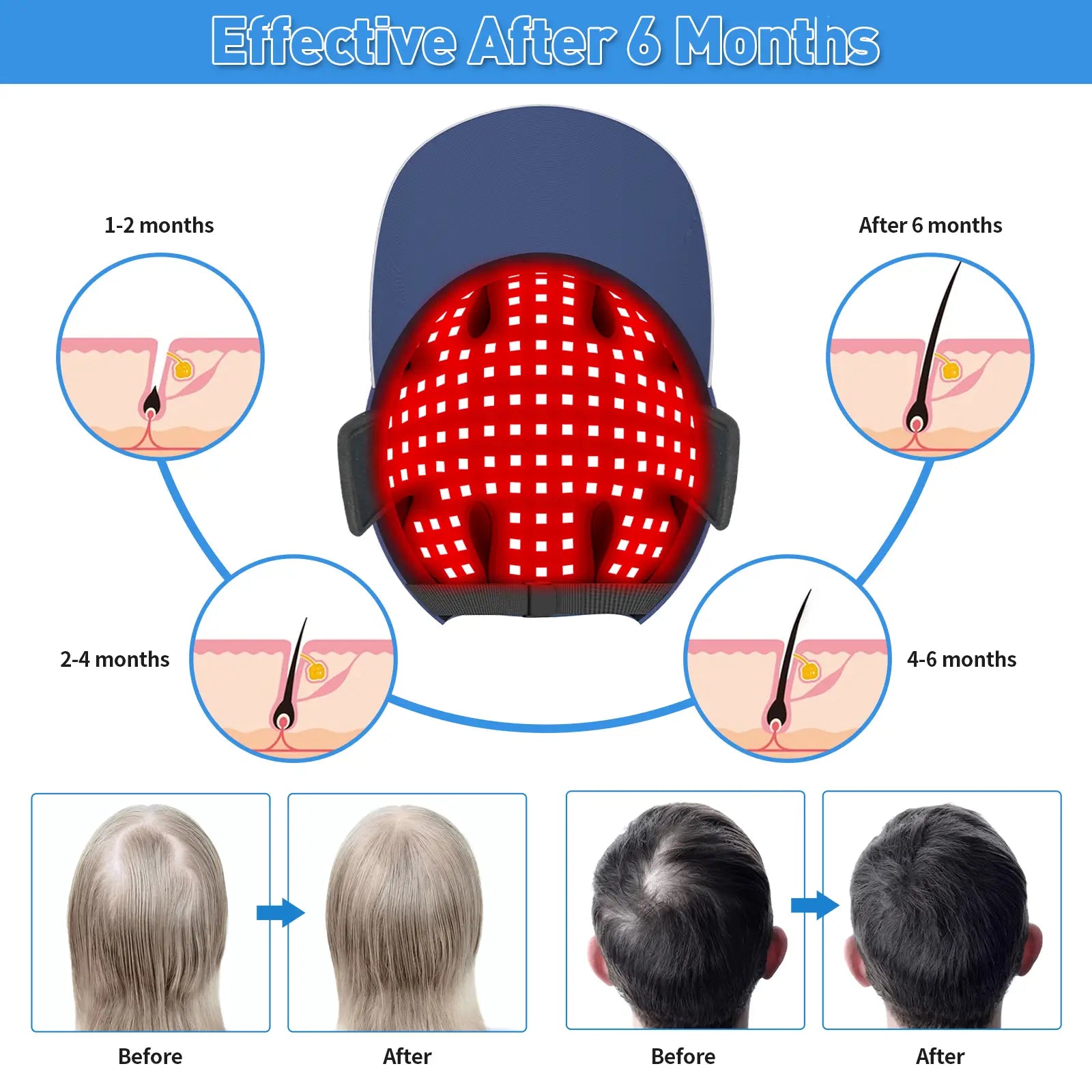 Hair regrowth results timeline using red light therapy cap, effective after 6 months.